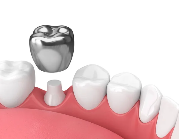 Step by step illustration of a dental crown procedure