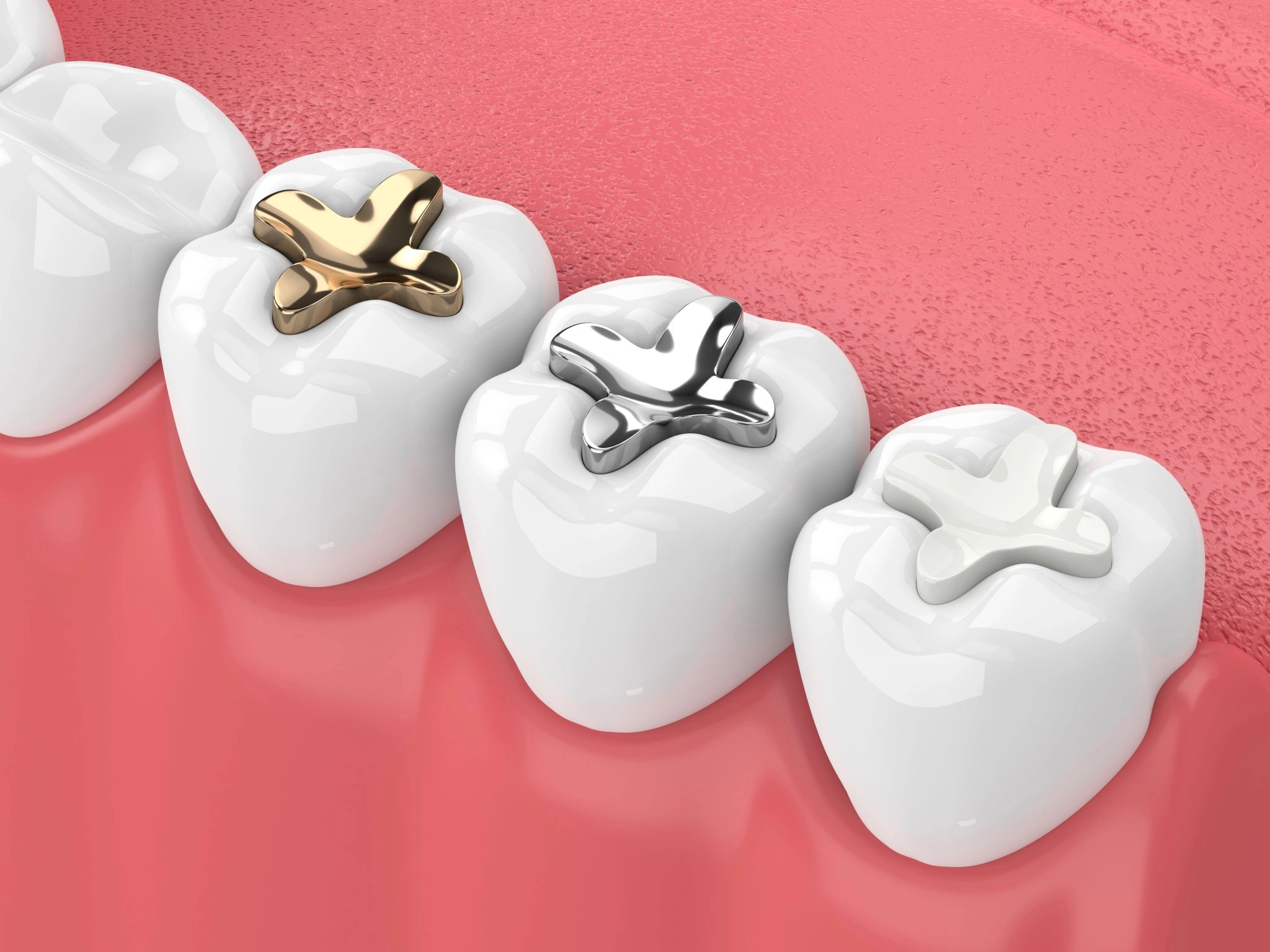 Dental sealants protecting teeth from cavities