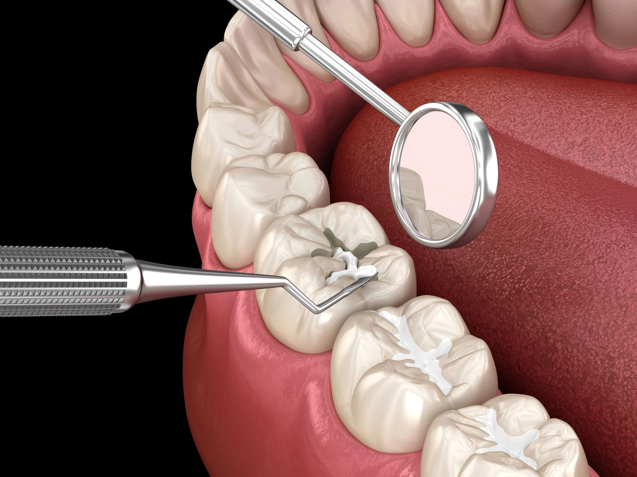 Dentist examining a tooth protected with dental sealants