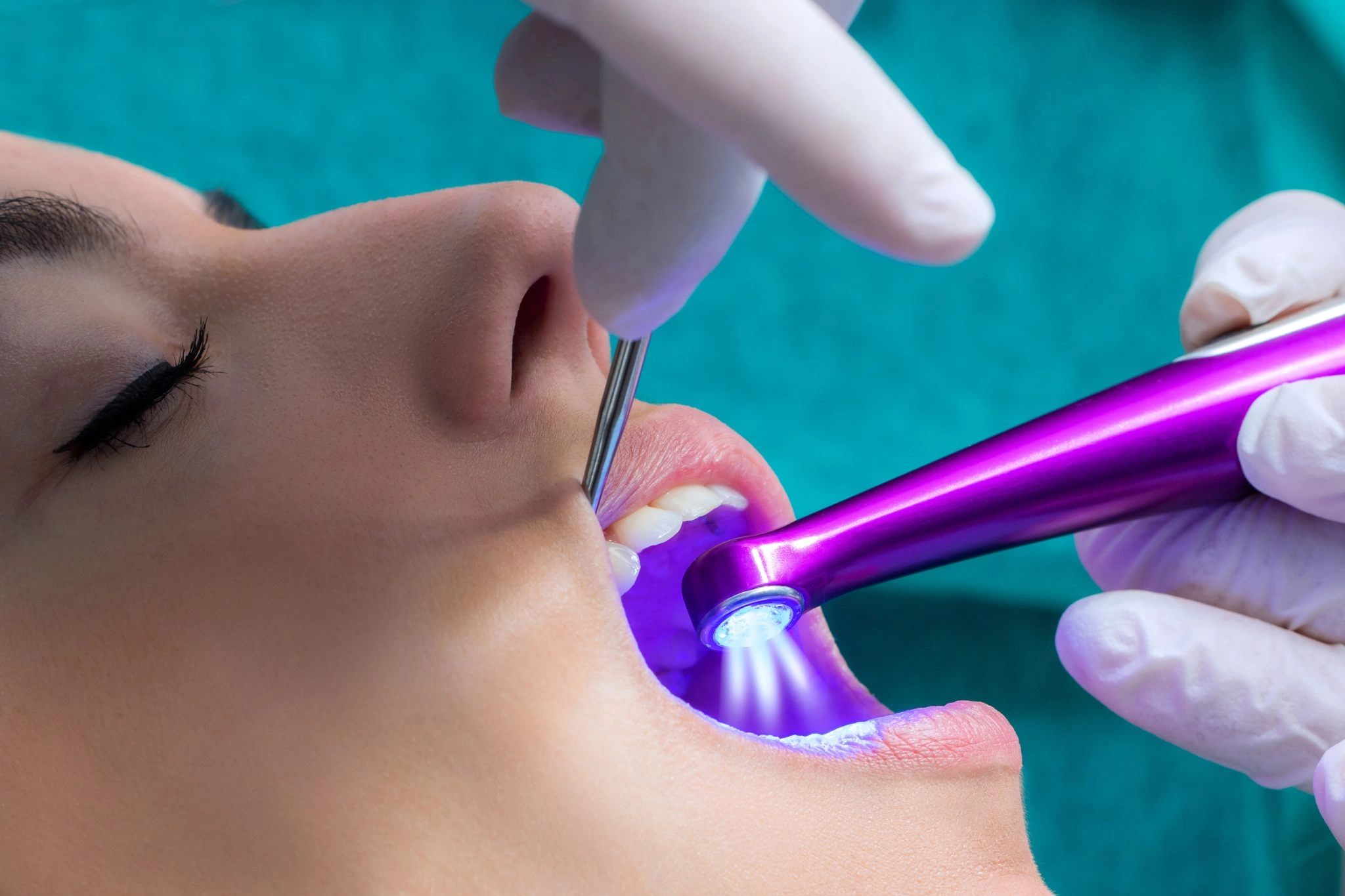Dental sealant being applied to a patient's tooth