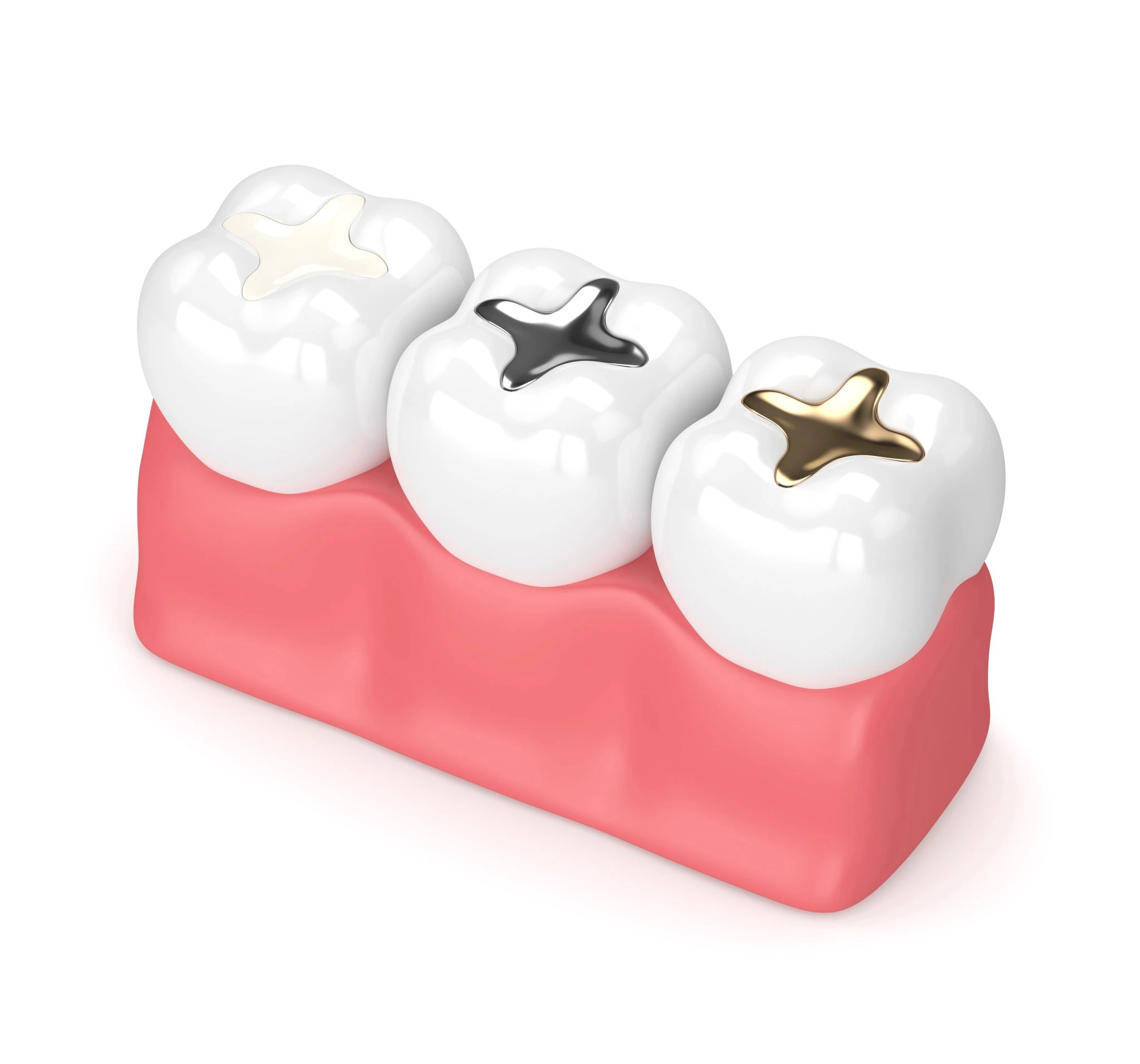 Illustration of molars protected with dental sealants