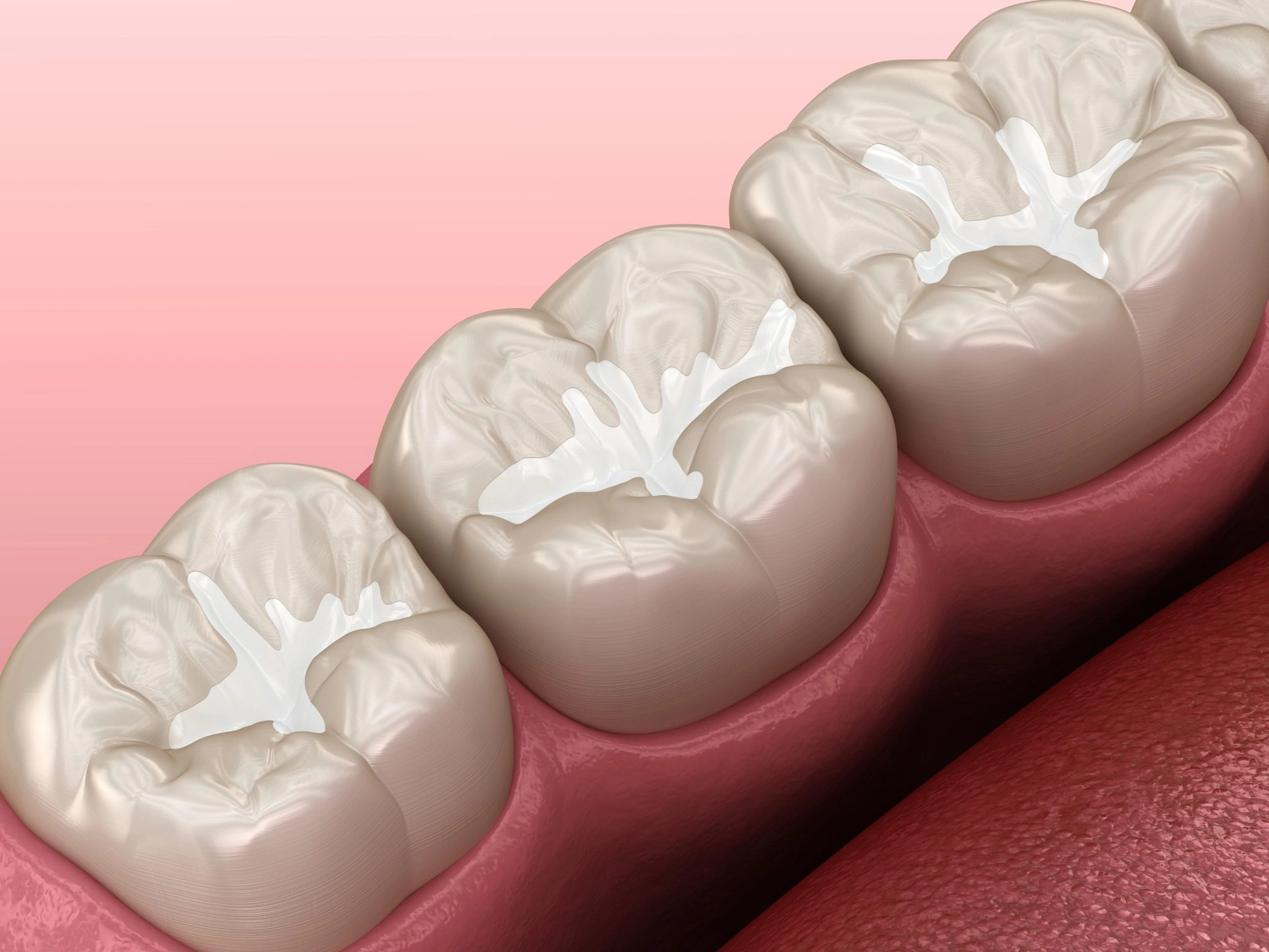 Close up illustration comparing dental sealants and fillings