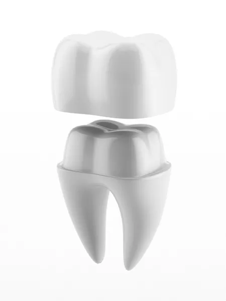 Illustration of a dental implant and crown restoration