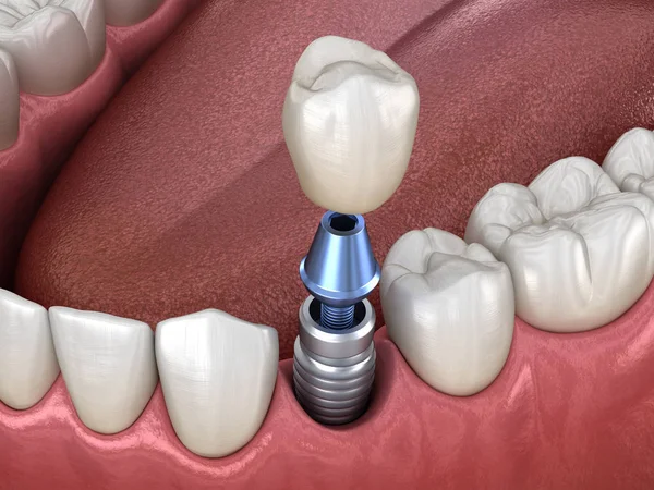 Dental implant crown placed on a model of teeth