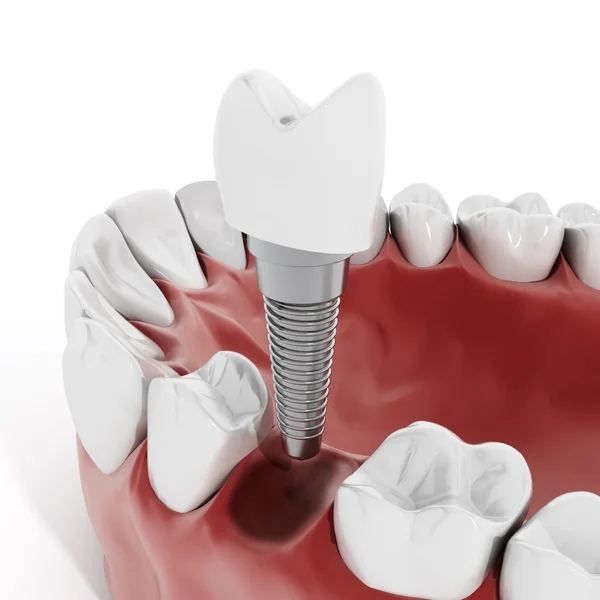 Illustration showing signs of tooth loss and replacement options