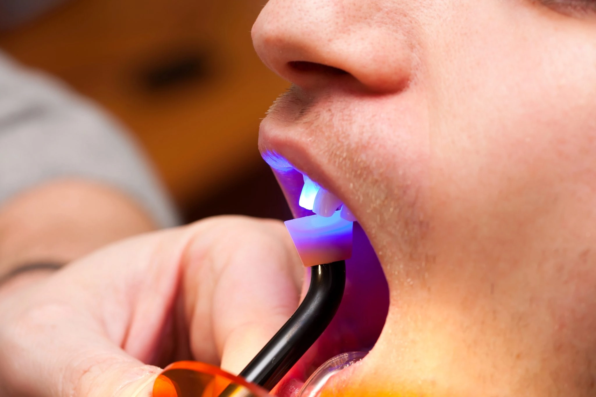 Close up of teeth whitening treatment in progress