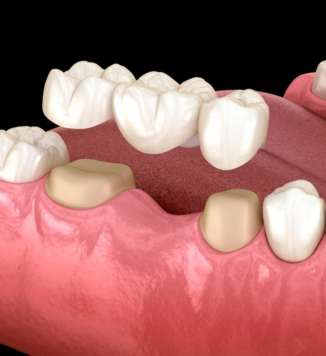 3D diagram showing a dental bridge placement to replace a missing tooth at Chatfield Smiles in Littleton