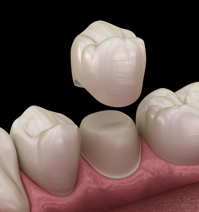 3D illustration of a dental crown being placed over a prepared tooth at Chatfield Smiles in Littleton, CO