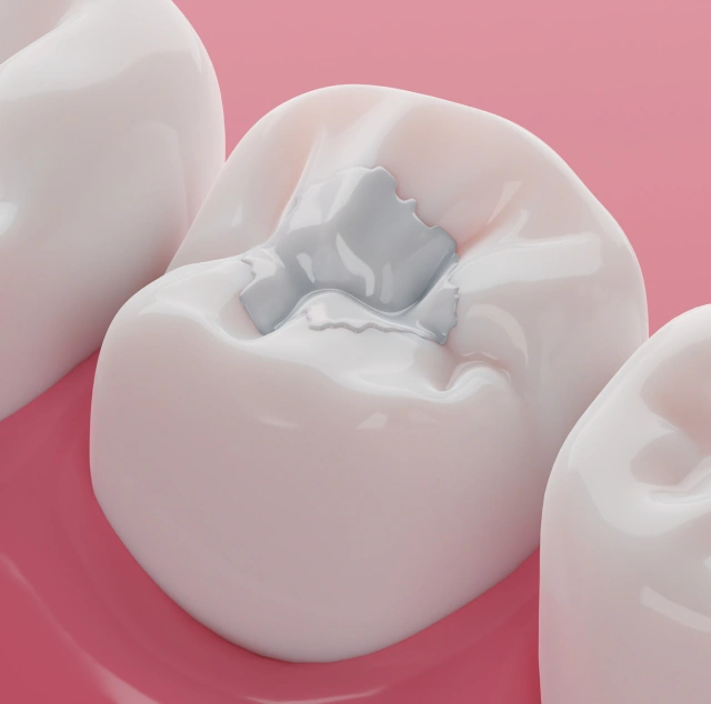 3D illustration of a dental filling placed in a molar tooth at Chatfield Smiles in Littleton, CO