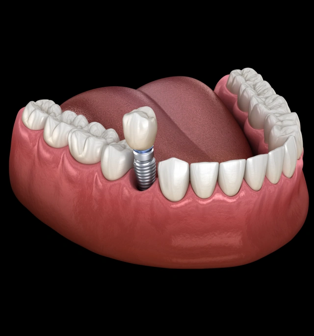 3D diagram of a tooth implant screw and dental crown restoration at Chatfield Smiles in Littleton, CO