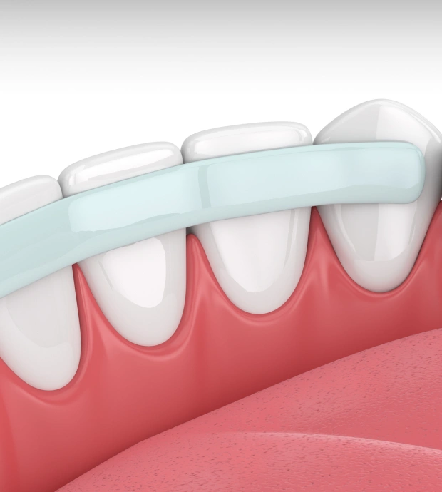 3D dental graphic showing a tooth restoration using cosmetic dental bonding
