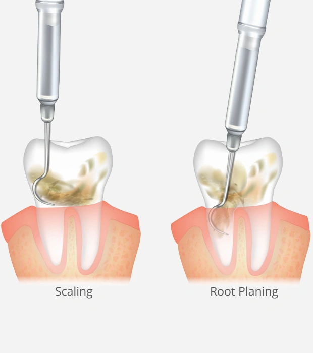 Medical illustration of a scaling and root planing deep cleaning procedure for periodontal health